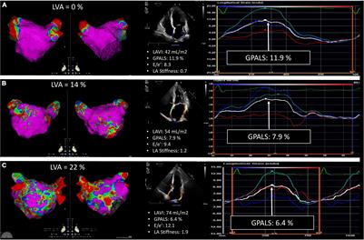 Prediction of Left Atrial Fibrosis and Success of Catheter Ablation by Speckle Tracking Echocardiography in Patients Imaged in Persistent Atrial Fibrillation